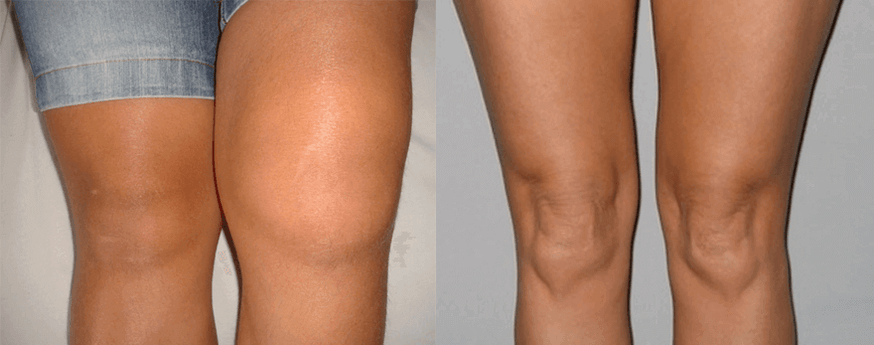 Erleben Sie die Verwendung von Cannabisölkapseln vor und nach der Verwendung von Eva